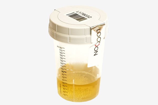 Partial Sample with Urine collection vessel